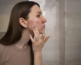 Donna applica crema su viso arrossato, cercando sollievo dalle piaghe della pelle.