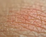 Close-up della pelle con arrossamento, suggerisce irritazione piega sedere rimedi.