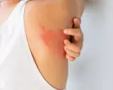 Un'eruzione cutanea rossa e pruriginosa sulla spalla, che fa sudare dietro la nuca per il disagio.