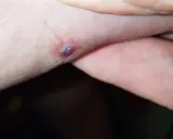 Una piccola piaga da decubito che sanguina, con un'area violacea al centro, su pelle chiara.