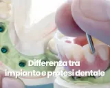 Modello dentale con impianti e protesi. L'igiene del cavo orale è fondamentale per la salute dei denti.