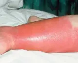 Gamba gonfia e arrossata, con segni di erisipela. La pelle appare lucida e tesa, con un'area di infiammazione estesa.