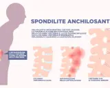 Spondilite anchilosante: infiammazione vertebrale che causa fusione ossea, rendendo la colonna rigida e curva in avanti.