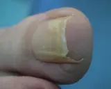 Dettaglio di un'unghia del piede con ispessimento e curvatura, che ricorda un'unghia a uncino.