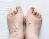Piedi anziani con evidenti vene varicose e dita leggermente deformate, segno di piedi gonfi anziani.