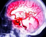 Immagine radiografica di un cervello con vasi sanguigni rossi evidenziati, che simboleggiano la lotta per l'aneurisma cerebrale sopravvivenza.