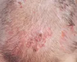 Primo piano del cuoio capelluto con arrossamenti e croste, tipici di condizioni cutanee che possono colpire gli anziani.