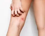 Mano che si gratta l'interno coscia con arrossamento. Possibili rimedi per l'irritazione interno coscia.