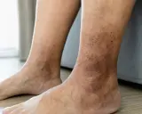 Gambe e caviglie con macchie scure e arrossamenti, indicative di dermatite da stasi.