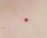 Una piccola macchia rossa sulla pelle, di forma quasi circolare, spicca sulla cute chiara.