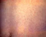 Pelle arrossata con piccole piaghe sotto la pancia, simili a puntini rossi diffusi.