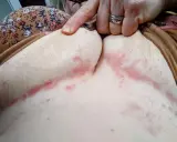 Pelle arrossata e irritata sotto il seno, con segni di piaghe da decubito. Una mano indica l'area interessata.