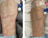 Braccio con segni di flebite, con vene rosse e gonfie in A, e un braccio più sano in B, con catetere venoso.