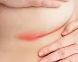 Arrossamento e irritazione cutanea sotto il seno, sintomo di dermatite da sudore. Mani che accarezzano delicatamente la zona interessata.