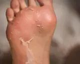 Piedi con pelle che si sfalda, possibili piaghe da sudore.