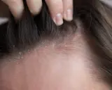 Dettaglio del cuoio capelluto con squame biancastre e arrossamento, indicativo di dermatite atopica.