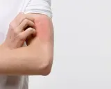 Braccio con arrossamento e prurito, possibile eczema diabetico.