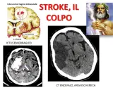 Immagini mediche mostrano ictus cerebrali, emorragici e ischemici. La vasculopatia cerebrale cronica può influenzare l'aspettativa di vita.