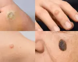 Primo piano di una verruca sul dito di una mano, un'altra sul piede e una lesione cutanea sul viso.
