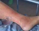 Gamba con edema e ulcere alle caviglie, la pelle è arrossata e screpolata, con aree di necrosi.