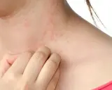 Pelle arrossata e irritata sul collo, con piccole pustole rosse. Una mano si gratta, sintomo di sudore e prurito.