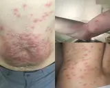 Eruzione cutanea diffusa su addome, braccio e schiena, con pomfi rossi. Potrebbe essere utile sapere quanto dura la puntura di acaro per gestire il prurito.
