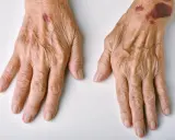 Mani anziane con macchie di sangue sulla pelle, segni di fragilità e fragilità cutanea.