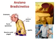 Anziani con difficoltà a parlare, tremore, postura curva e rigidità. Illustrazione e foto di persone anziane con sintomi di bradicinesia.