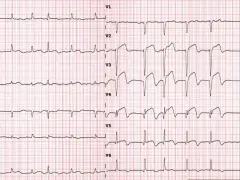 ECG mostra un ritmo rapido e irregolare con complessi QRS larghi, indicativo di tachicardia ventricolare.