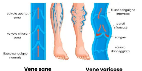 Illustrazione che mostra vene sane e vene varicose, evidenziando i problemi di insufficienza venosa gambe rimedi.
