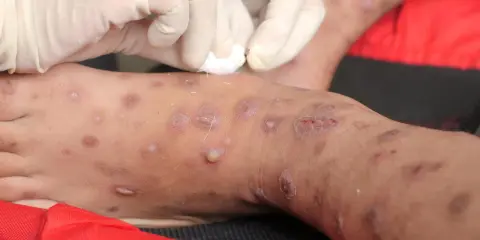 Gambe con lesioni cutanee, forse trattate con scabbia rimedi della nonna. Mani con guanti applicano un trattamento.