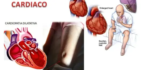 Illustrazione che mostra un cuore normale e ingrossato, un paziente con sintomi di scompenso cardiaco e fluidi polmonari. Lo scompenso cardiaco può regredire con cure adeguate.