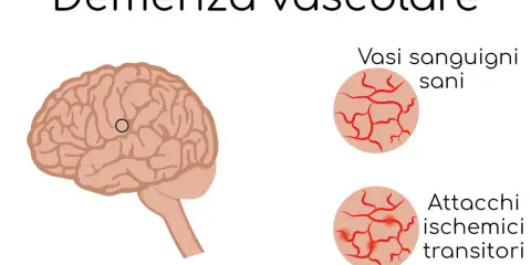 Illustrazione del cervello con un cerchio che indica un'area interessata da vasculopatia cerebrale cronica nell'anziano. Confronto tra vasi sanguigni sani e quelli colpiti da attacchi ischemici transitori.