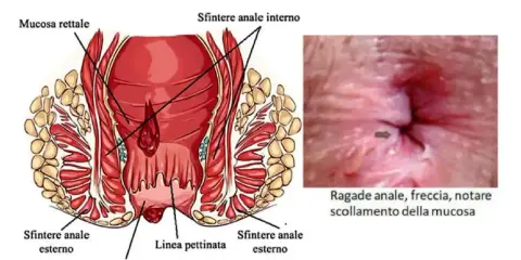 Illustrazione anatomica dell'ano e immagine di una ragade anale, che può causare dermatite perianale.