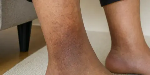 Gambe con macchie scure, segno di problemi di circolazione. La pelle presenta discromie evidenti nella zona della caviglia.