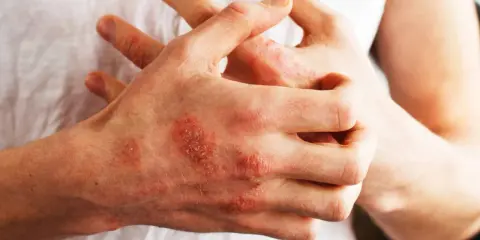 Mani con chiazze rosse e squamose, segno di psoriasi. Nonostante non sia mortale, la psoriasi può avere un impatto devastante sulla qualità della vita.
