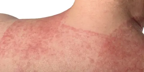 Pelle arrossata e irritata sulla spalla e sul collo, con chiazze evidenti. Potrebbe essere un caso di dermatite da incontinenza.