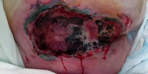 Grave lesione da decubito con tessuto necrotico e sanguinamento. La prevenzione piaghe da decubito è fondamentale per evitare queste condizioni.