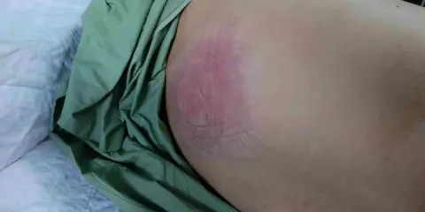 Arrossamento e lesione cutanea, possibile piaga da decubito nera come curarla. Necessario intervento medico.