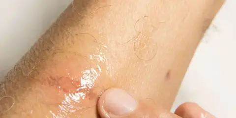 Dito, un dito preme su una lesione cutanea umida e arrossata, forse causata da sudare sempre.