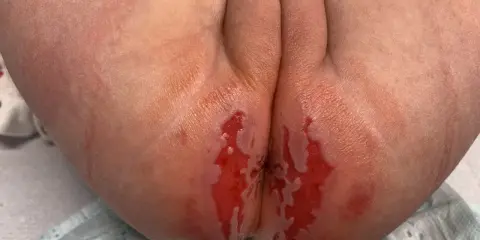 Pelle arrossata e irritata, con aree umide e lucide, tipica della dermatite da pannolino. Quanto dura? Dipende da cure e tempestività.