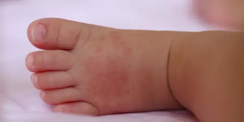 Piedino di neonato con piccoli puntini da sudore rossastri sulla pelle.