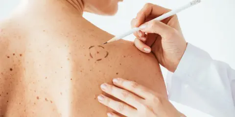 Medico disegna cerchio su neo per asportazione. La convalescenza dopo asportazione neo è un momento delicato.
