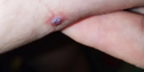 Una piccola piaga da decubito che sanguina, con un'area violacea al centro, su pelle chiara.