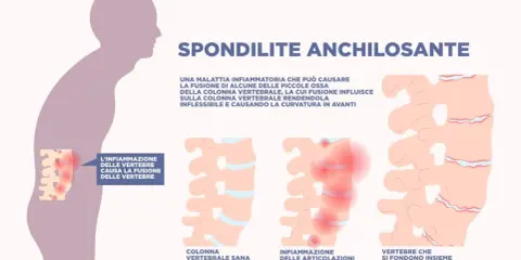 Spondilite anchilosante: infiammazione vertebrale che causa fusione ossea, rendendo la colonna rigida e curva in avanti.
