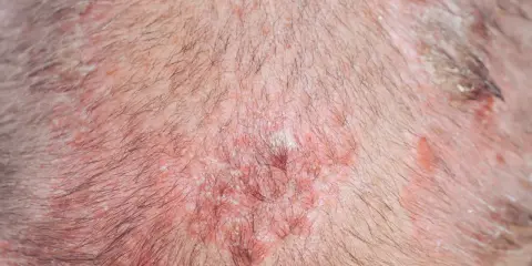 Primo piano del cuoio capelluto con arrossamenti e croste, tipici di condizioni cutanee che possono colpire gli anziani.