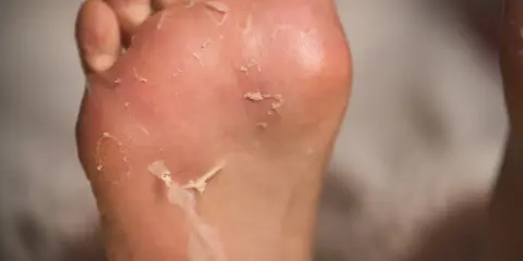 Piedi con pelle che si sfalda, possibili piaghe da sudore.