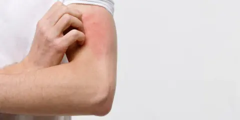 Braccio con arrossamento e prurito, possibile eczema diabetico.