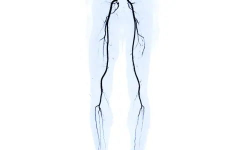 Angiografia delle gambe che mostra l'arteria femorale ostruita, un sintomo di problemi circolatori.