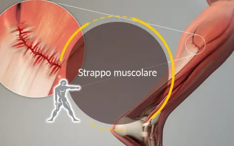 Illustrazione anatomica di uno strappo muscolare, con ingrandimento che mostra la sutura di una lesione muscolare.